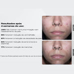 Sérum Pro-Adapaleno Anti-acne e Anti-aging - Creamy